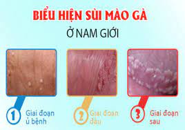 DẤU HIỆU SÙI MÀO GÀ Ở NAM, NGUYÊN NHÂN VÀ CÁCH HỖ TRỢ ĐIỀU TRỊ MỚI